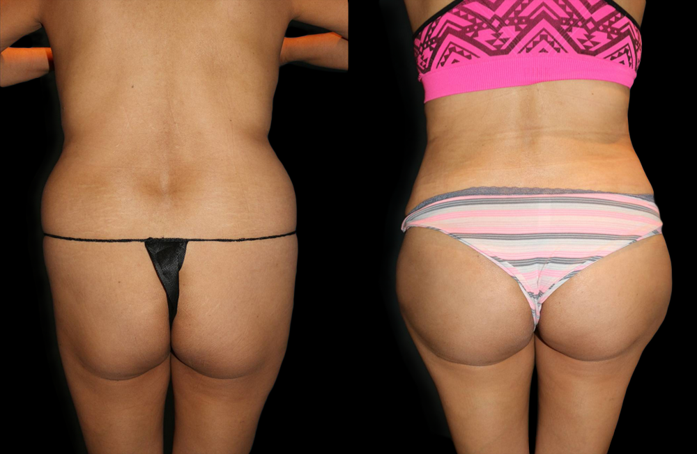 Brazilian Butt Lift Before and After Photo by Dr. Roger Tsai in Beverly Hills