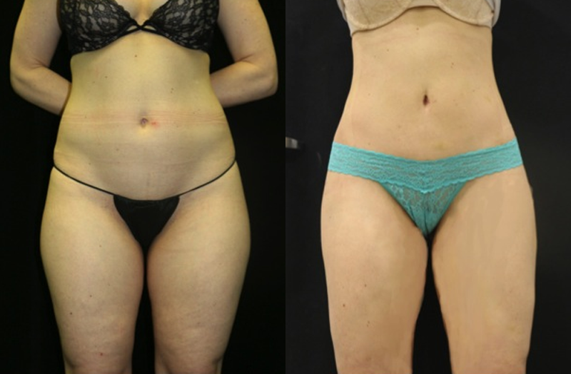 Liposuction Before and After Photo by Dr. Roger Tsai in Beverly Hills