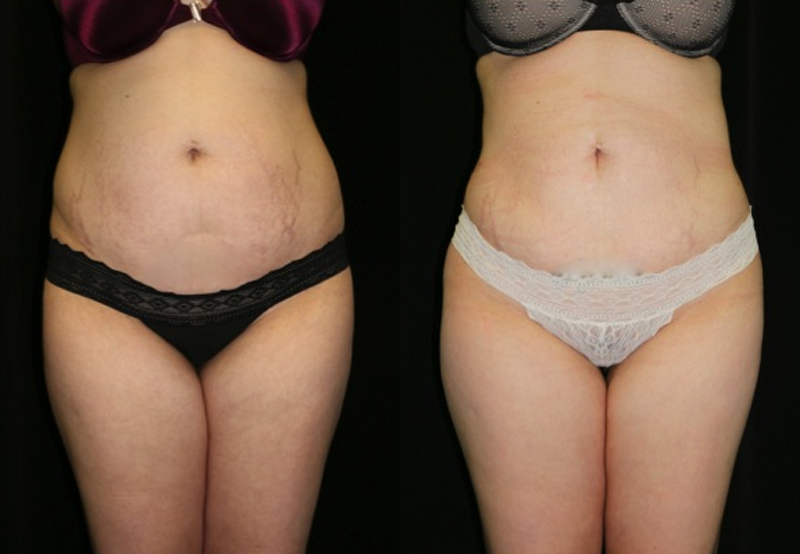 Liposuction Before and After Photo by Dr. Roger Tsai in Beverly Hills