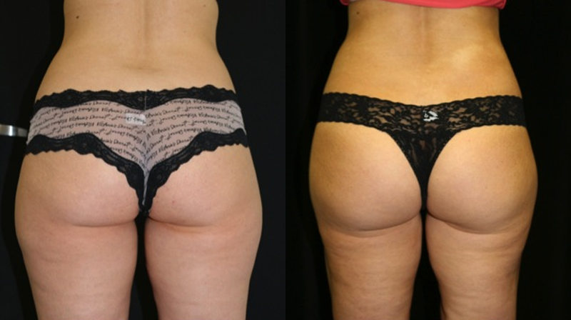 Liposuction Before and After Photo by Dr. Roger Tsai in Beverly Hills