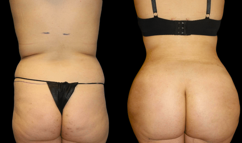 Liposuction Before and After Photo by Dr. Roger Tsai in Beverly Hills