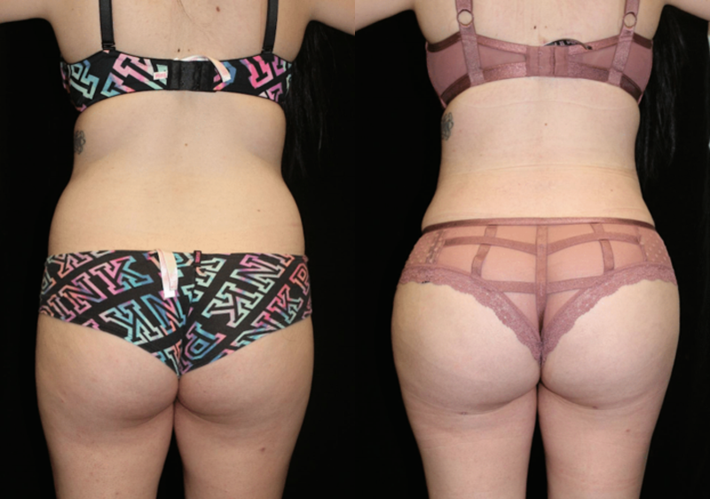 Liposuction Before and After Photo by Dr. Roger Tsai in Beverly Hills