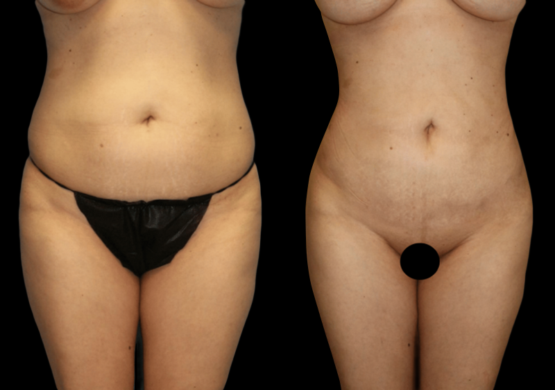 Liposuction Before and After Photo by Dr. Roger Tsai in Beverly Hills