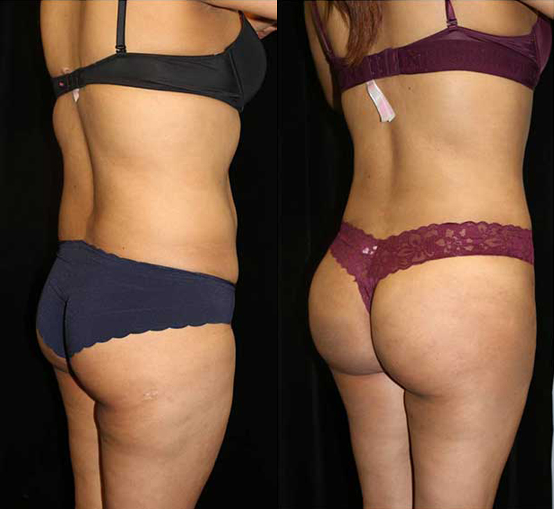 Liposuction Before and After Photo by Dr. Roger Tsai in Beverly Hills