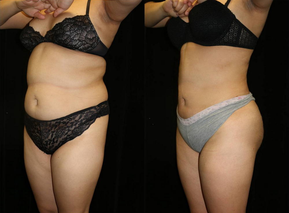 Liposuction Before and After Photo by Dr. Roger Tsai in Beverly Hills
