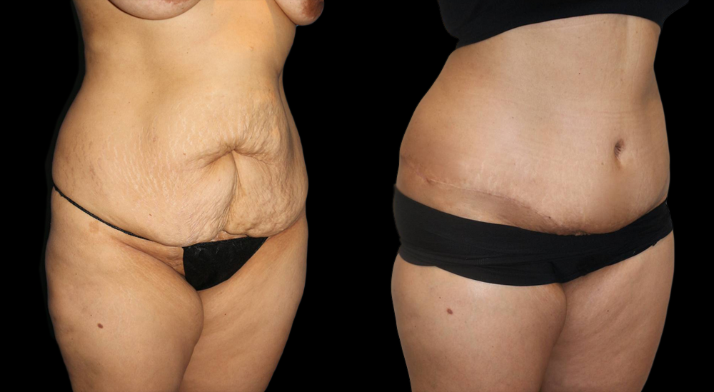 Tummy Tuck (Abdominoplasty) Before and After Photo by Dr. Roger Tsai in Beverly Hills