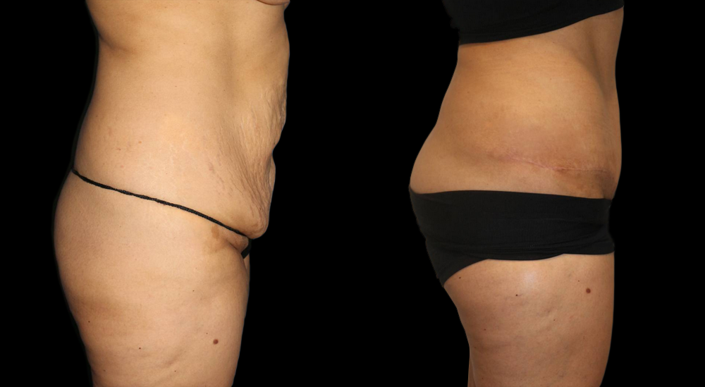 Tummy Tuck (Abdominoplasty) Before and After Photo by Dr. Roger Tsai in Beverly Hills