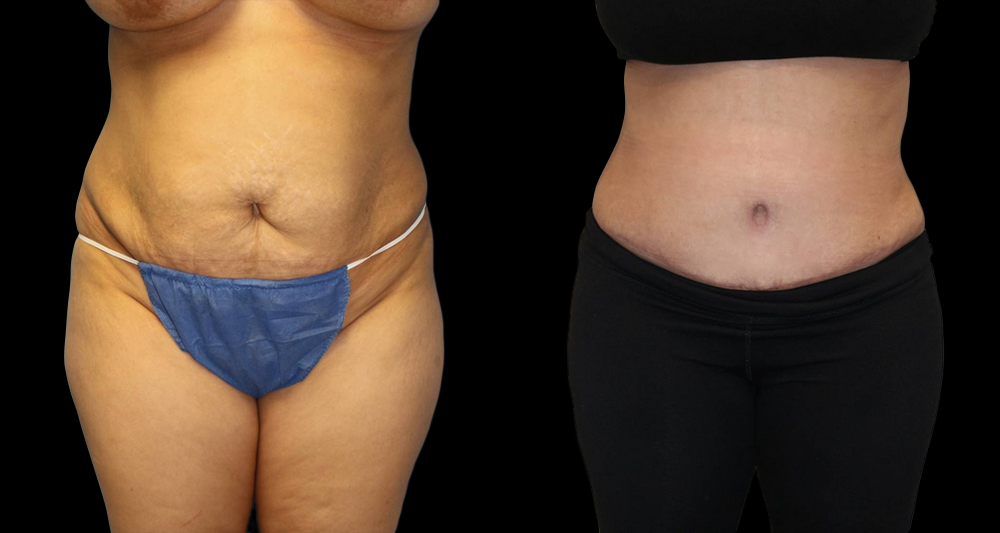 Tummy Tuck (Abdominoplasty) Before and After Photo by Dr. Roger Tsai in Beverly Hills