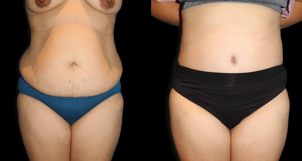 Tummy Tuck (Abdominoplasty) Before and After Photo by Dr. Roger Tsai in Beverly Hills