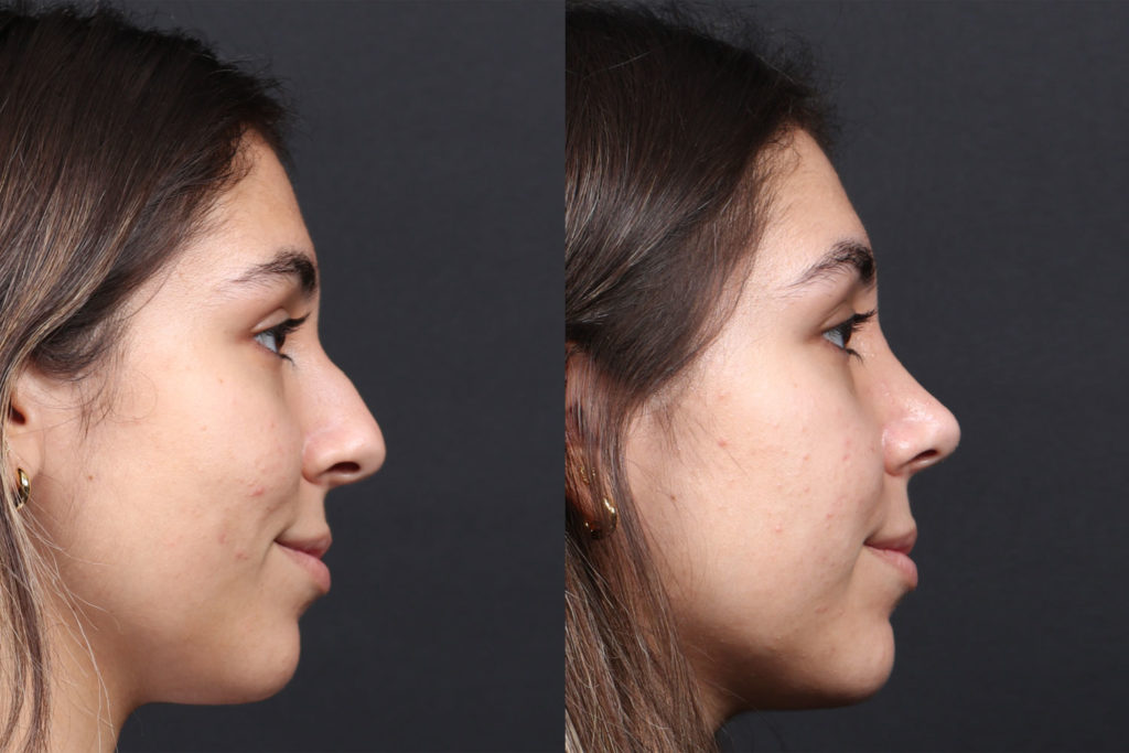 Rhinoplasty / Nose Surgery Before and After Photo by Dr. Roger Tsai in Beverly Hills