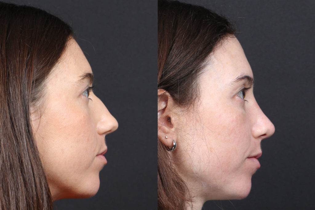 Rhinoplasty / Nose Surgery Before and After Photo by Dr. Roger Tsai in Beverly Hills