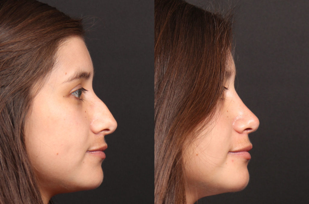 Rhinoplasty / Nose Surgery Before and After Photo by Dr. Roger Tsai in Beverly Hills