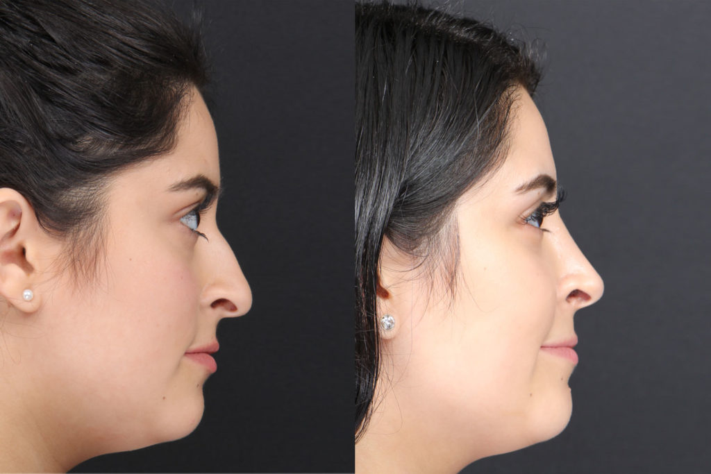 Rhinoplasty / Nose Surgery Before and After Photo by Dr. Roger Tsai in Beverly Hills