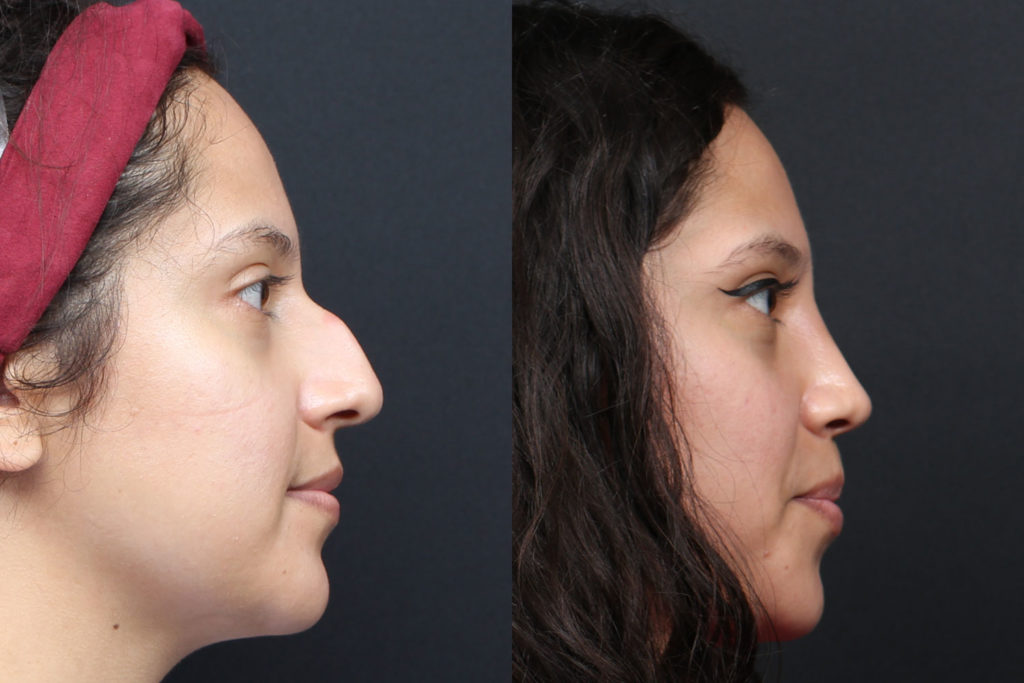 Rhinoplasty / Nose Surgery Before and After Photo by Dr. Roger Tsai in Beverly Hills