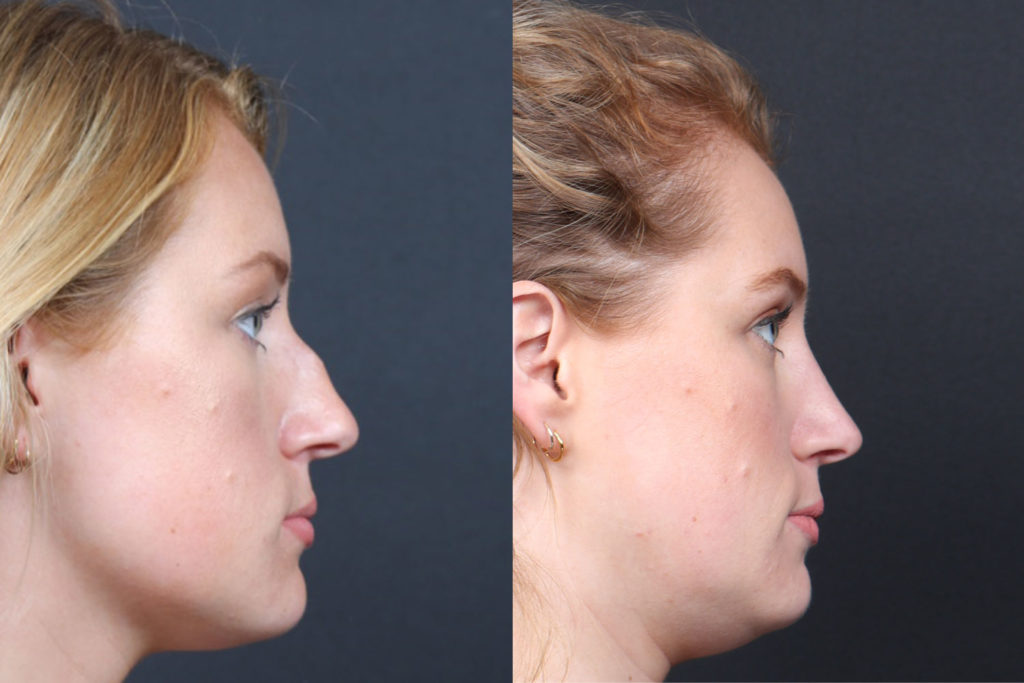 Rhinoplasty / Nose Surgery Before and After Photo by Dr. Roger Tsai in Beverly Hills