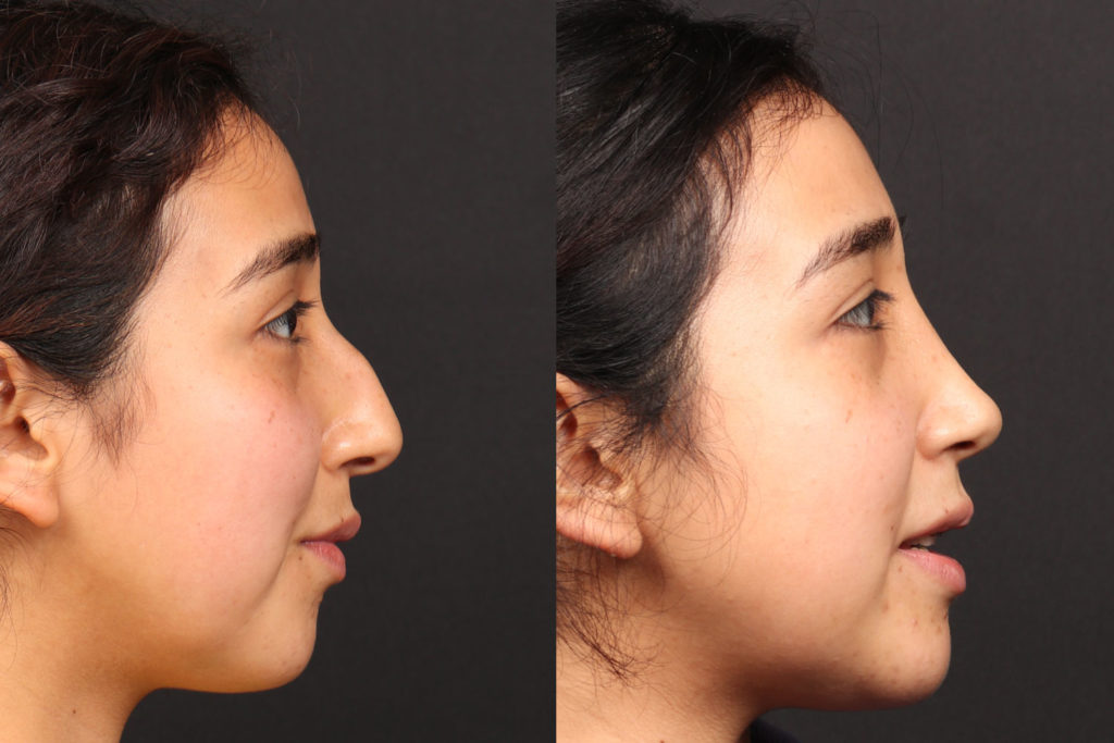 Rhinoplasty / Nose Surgery Before and After Photo by Dr. Roger Tsai in Beverly Hills