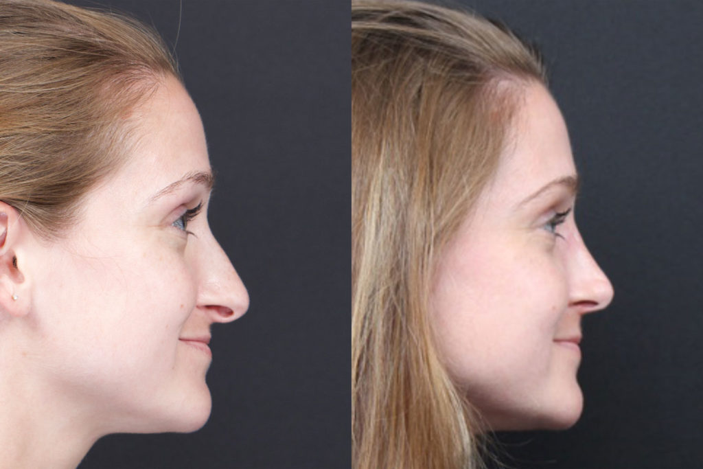 Rhinoplasty / Nose Surgery Before and After Photo by Dr. Roger Tsai in Beverly Hills