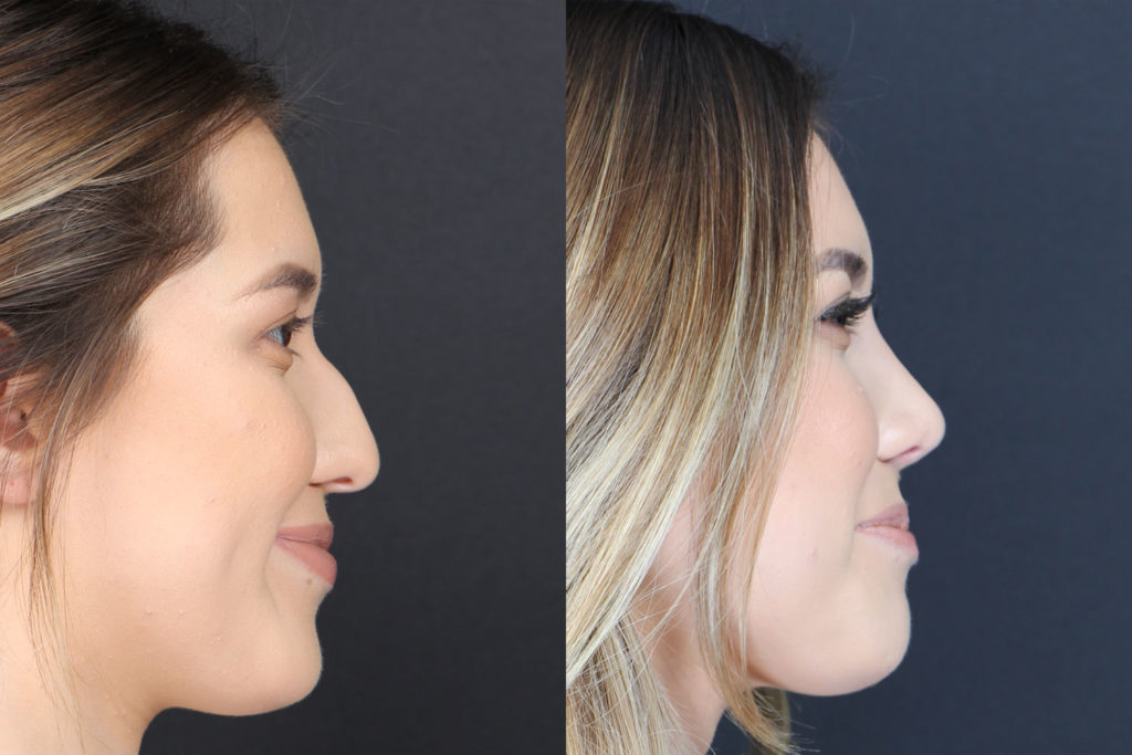 Rhinoplasty / Nose Surgery Before and After Photo by Dr. Roger Tsai in Beverly Hills