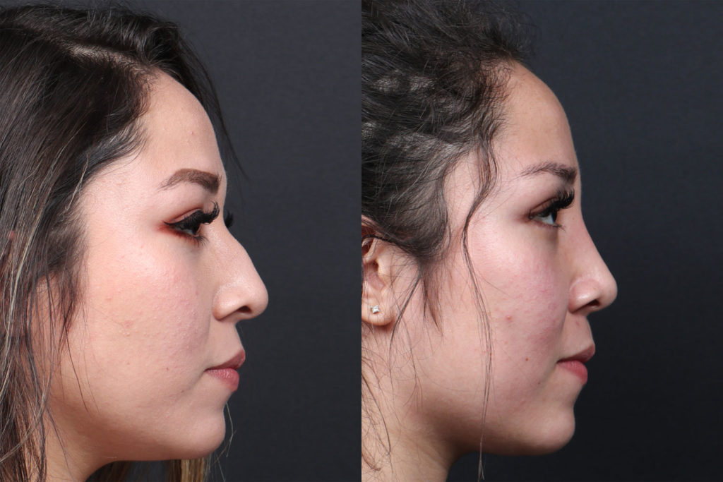 Rhinoplasty / Nose Surgery Before and After Photo by Dr. Roger Tsai in Beverly Hills