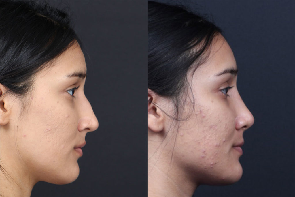 Rhinoplasty / Nose Surgery Before and After Photo by Dr. Roger Tsai in Beverly Hills