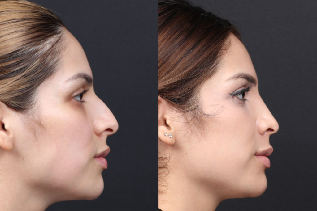 Rhinoplasty / Nose Surgery Before and After Photo by Dr. Roger Tsai in Beverly Hills