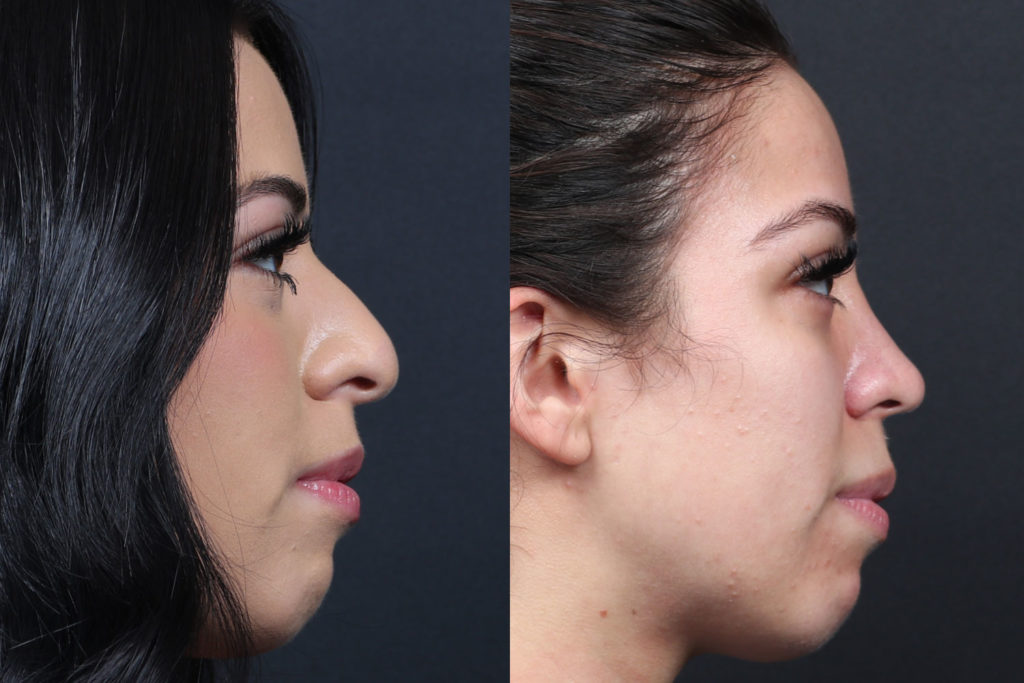 Rhinoplasty / Nose Surgery Before and After Photo by Dr. Roger Tsai in Beverly Hills