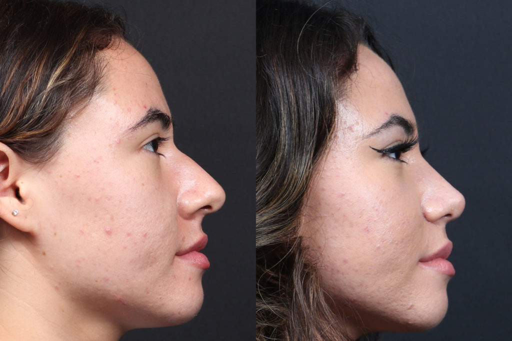 Rhinoplasty / Nose Surgery Before and After Photo by Dr. Roger Tsai in Beverly Hills