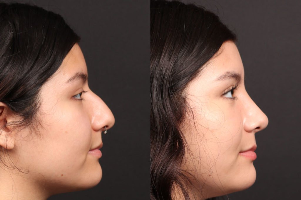 Rhinoplasty / Nose Surgery Before and After Photo by Dr. Roger Tsai in Beverly Hills