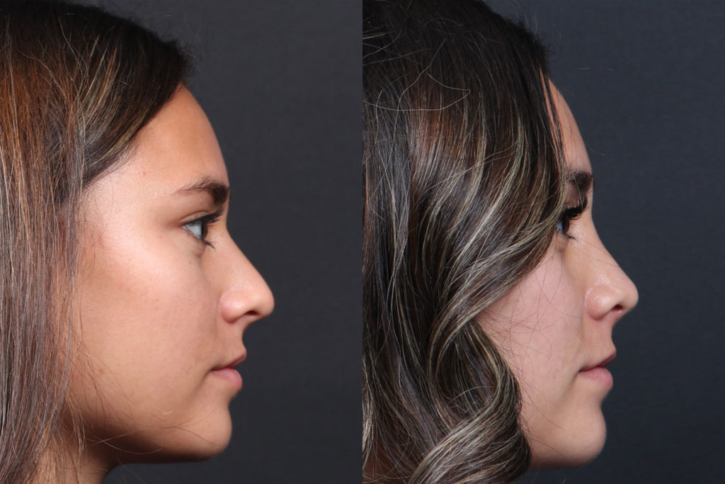 Rhinoplasty / Nose Surgery Before and After Photo by Dr. Roger Tsai in Beverly Hills