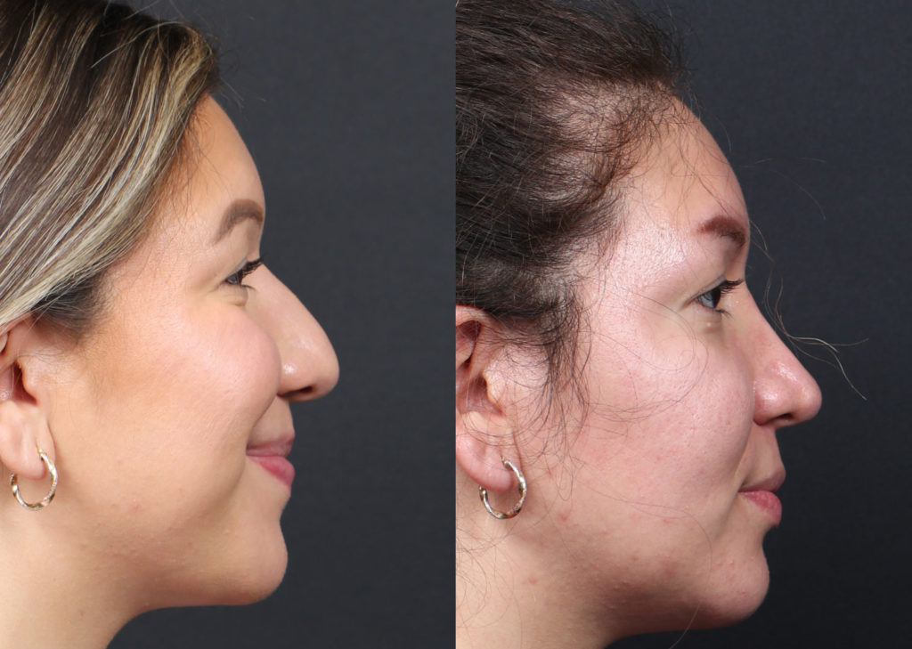 Rhinoplasty / Nose Surgery Before and After Photo by Dr. Roger Tsai in Beverly Hills