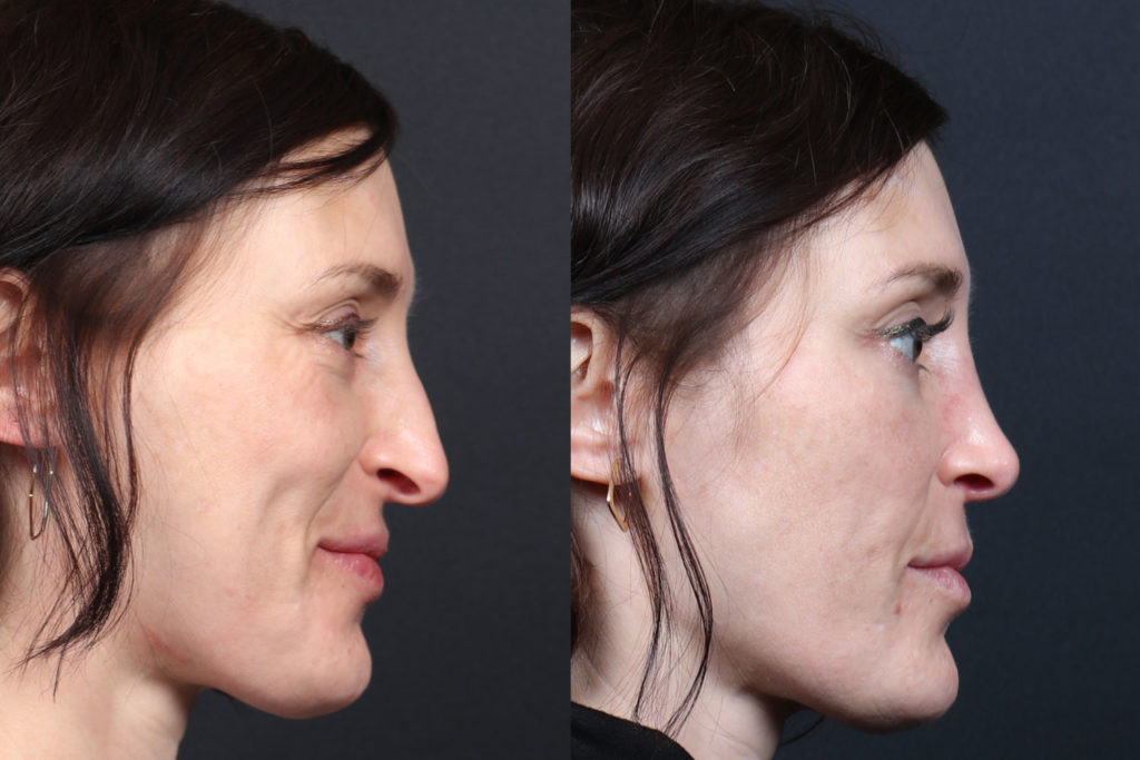 Rhinoplasty / Nose Surgery Before and After Photo by Dr. Roger Tsai in Beverly Hills