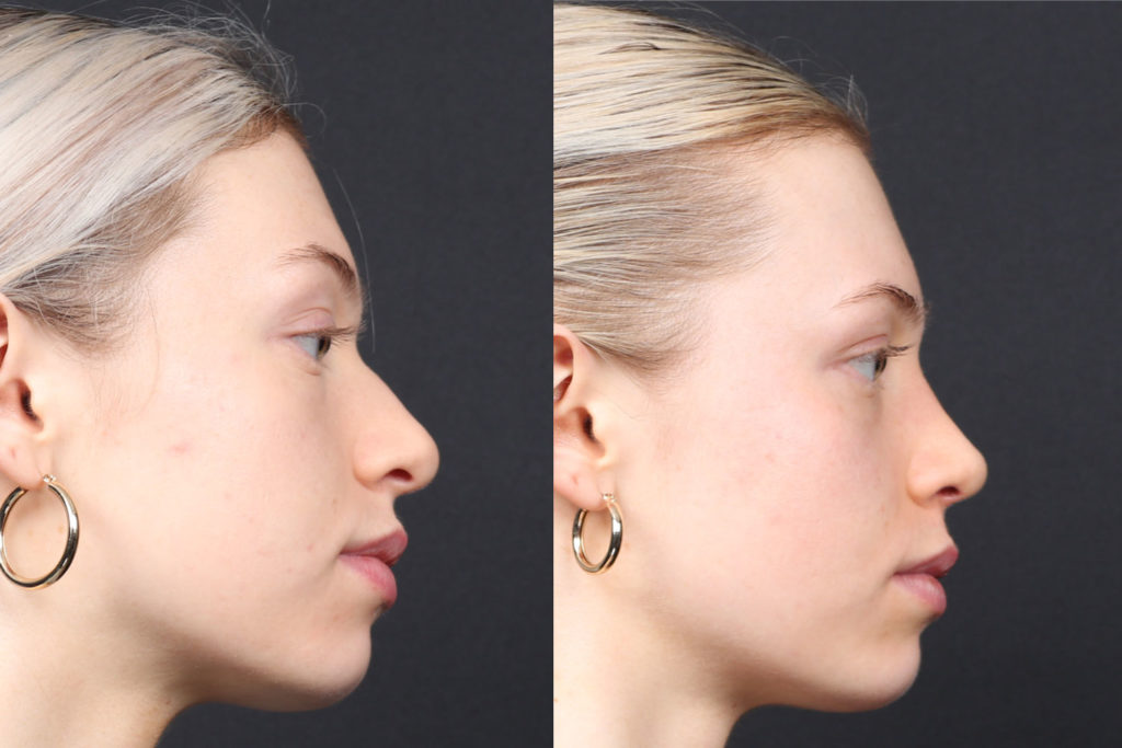 Rhinoplasty / Nose Surgery Before and After Photo by Dr. Roger Tsai in Beverly Hills