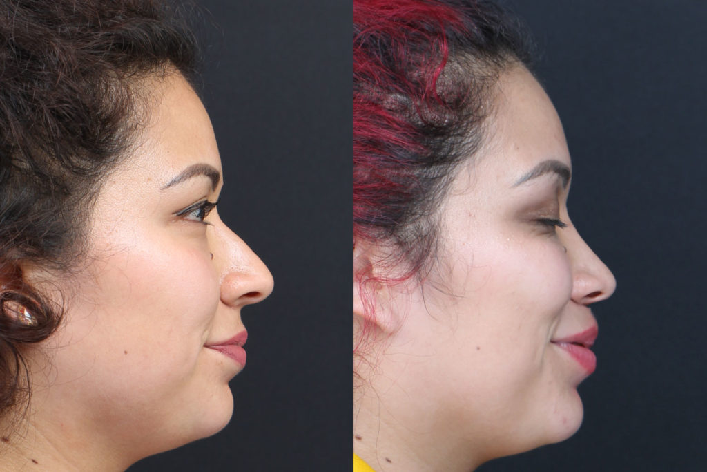 Rhinoplasty / Nose Surgery Before and After Photo by Dr. Roger Tsai in Beverly Hills