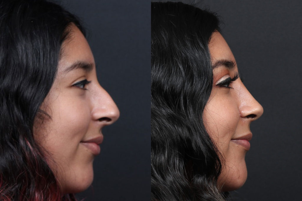 Rhinoplasty / Nose Surgery Before and After Photo by Dr. Roger Tsai in Beverly Hills