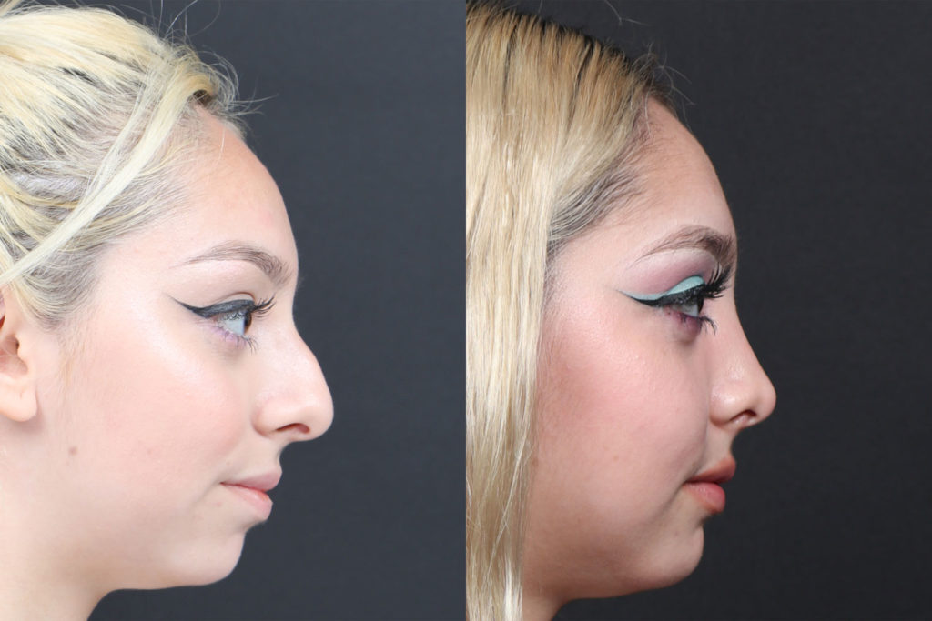 Rhinoplasty / Nose Surgery Before and After Photo by Dr. Roger Tsai in Beverly Hills