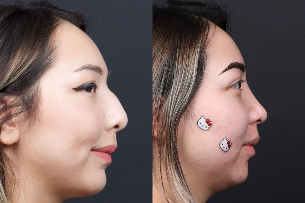 Rhinoplasty / Nose Surgery Before and After Photo by Dr. Roger Tsai in Beverly Hills