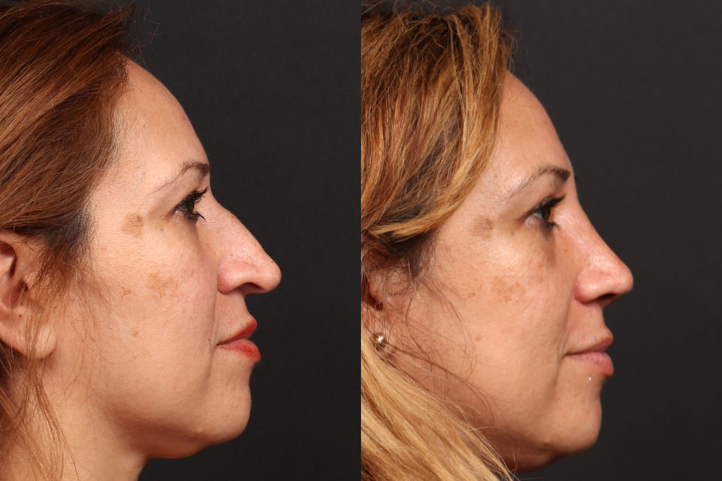 Rhinoplasty / Nose Surgery Before and After Photo by Dr. Roger Tsai in Beverly Hills