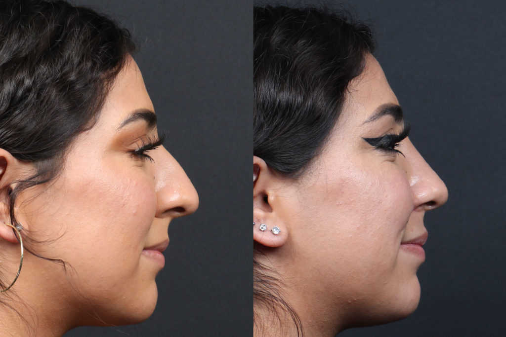 Rhinoplasty / Nose Surgery Before and After Photo by Dr. Roger Tsai in Beverly Hills