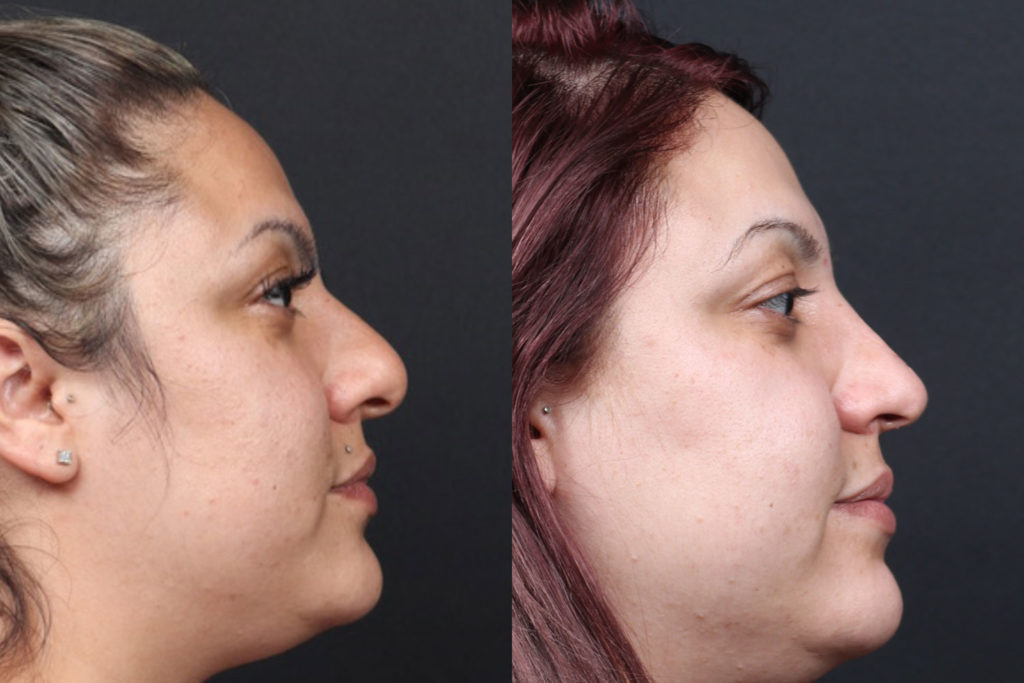 Rhinoplasty / Nose Surgery Before and After Photo by Dr. Roger Tsai in Beverly Hills