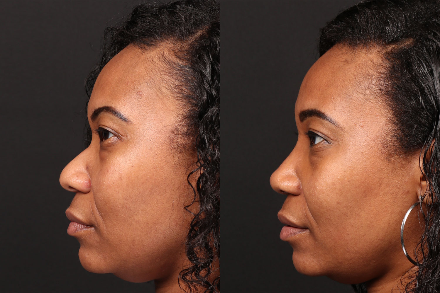 Rhinoplasty / Nose Surgery Before and After Photo by Dr. Roger Tsai in Beverly Hills