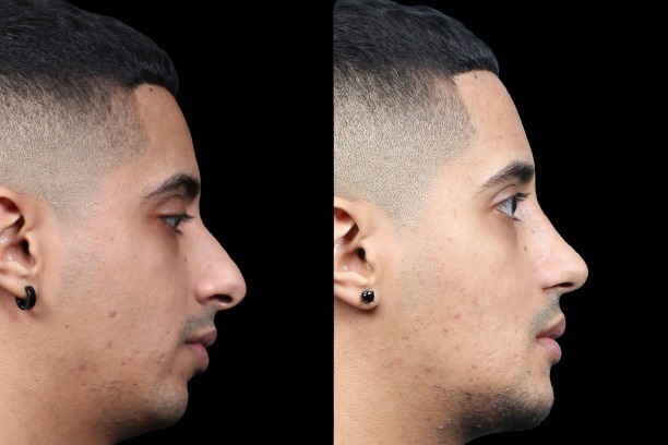 Rhinoplasty / Nose Surgery Before and After Photo by Dr. Roger Tsai in Beverly Hills