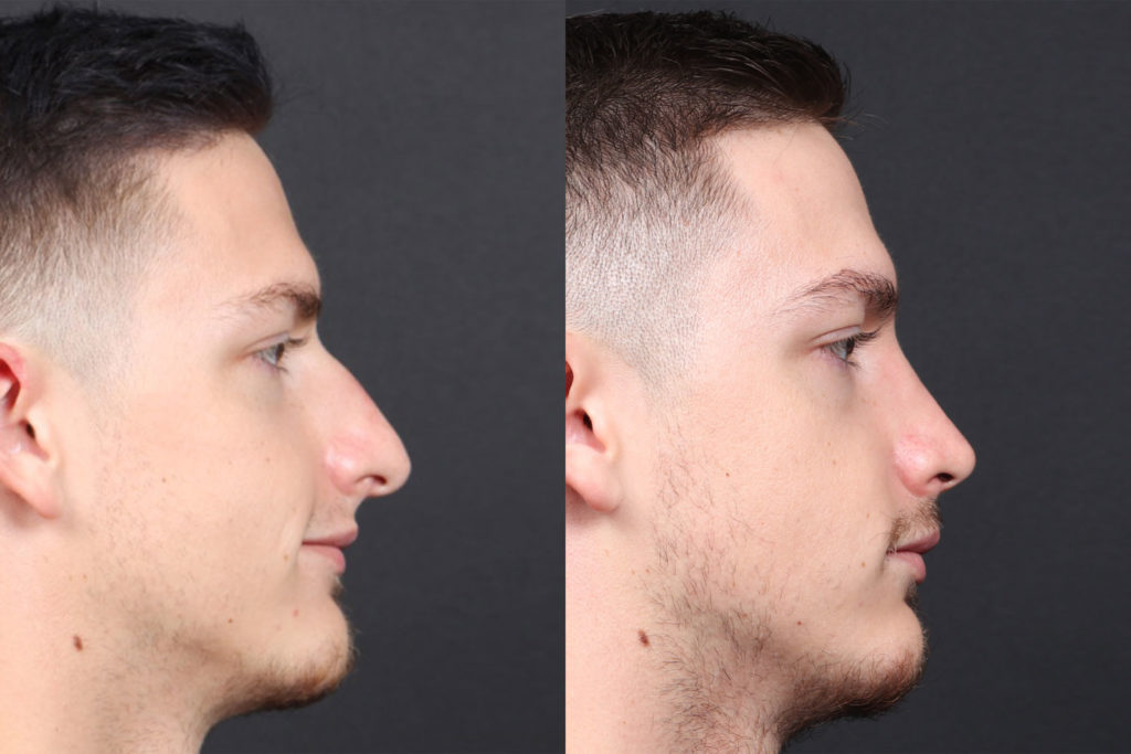 Rhinoplasty / Nose Surgery Before and After Photo by Dr. Roger Tsai in Beverly Hills