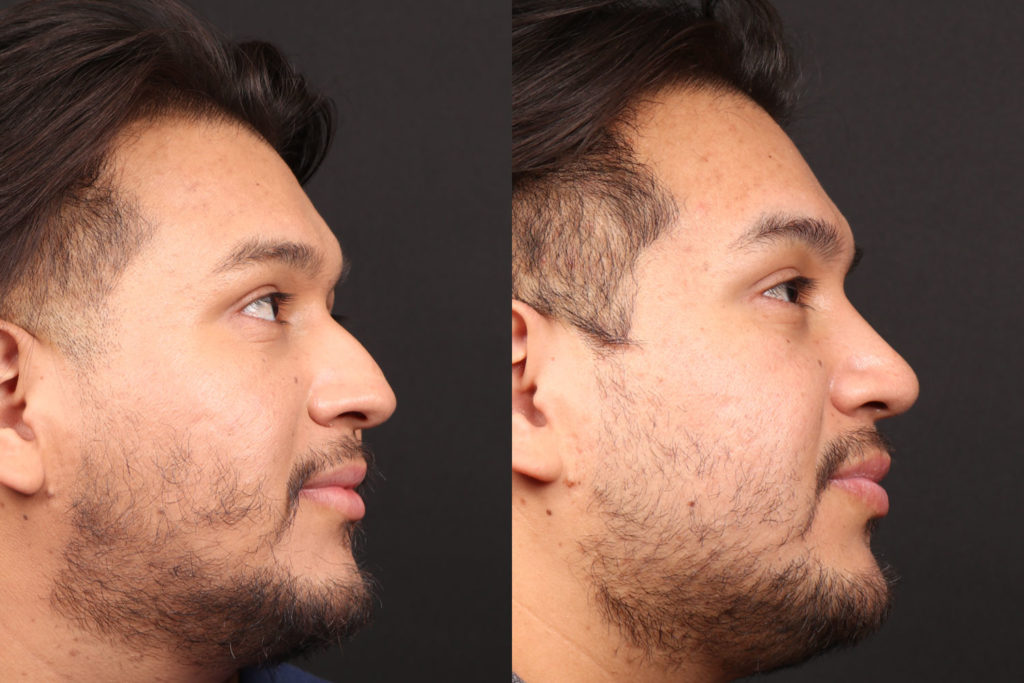 Rhinoplasty / Nose Surgery Before and After Photo by Dr. Roger Tsai in Beverly Hills