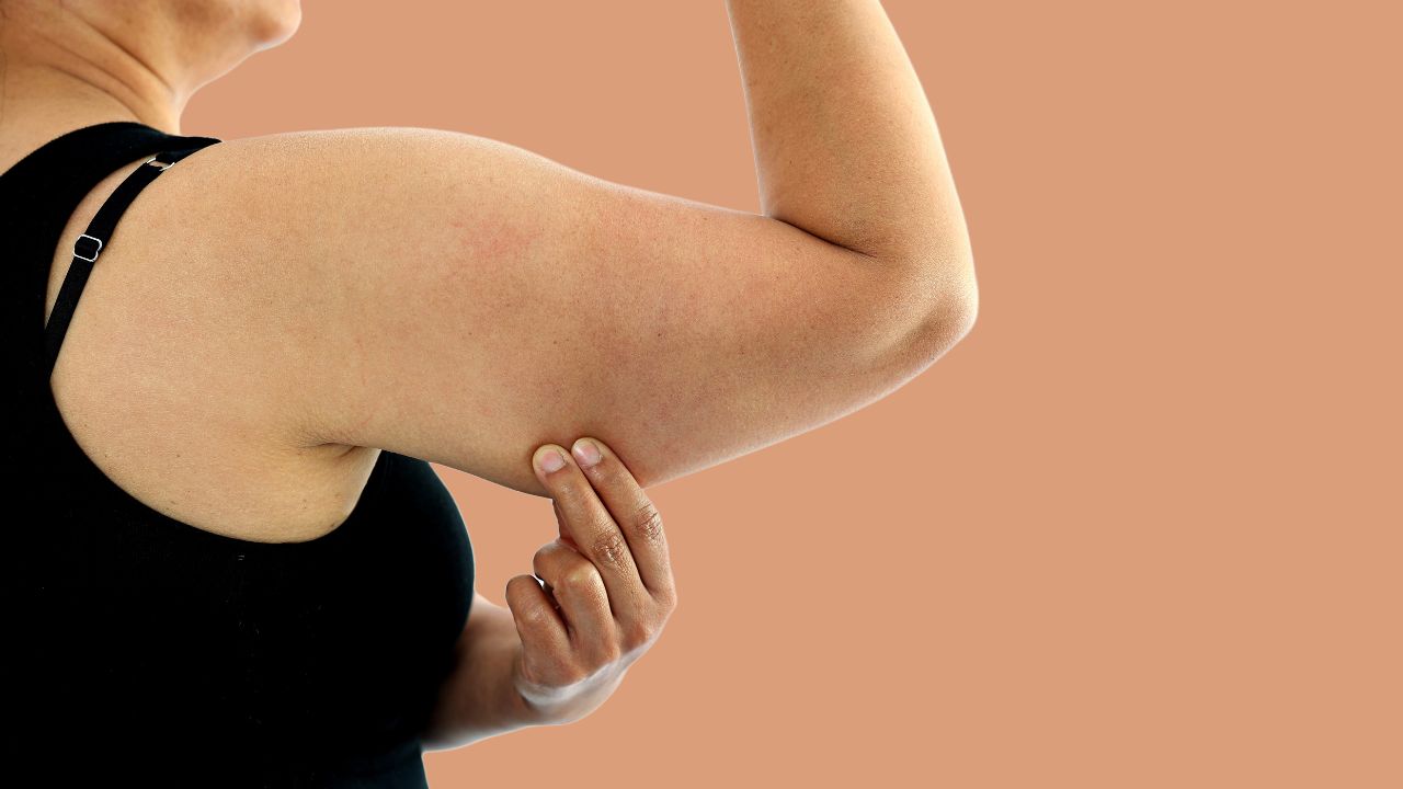 Can An Arm Lift Get Rid of Stretch Marks?
