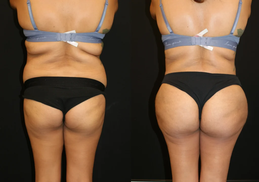 Back View Brazilian Butt Lift before and after photo by Dr. Tsai