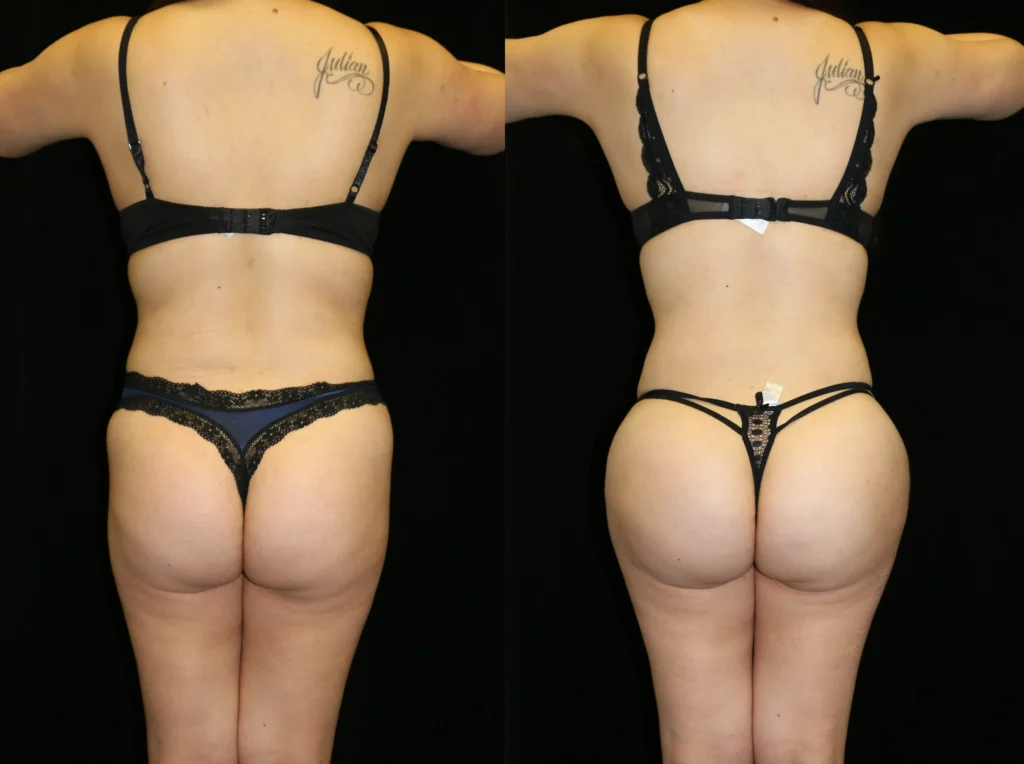 Back View Brazilian Butt Lift before and after photo by Dr. Tsai
