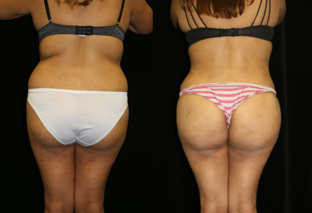 Back View Brazilian Butt Lift before and after photo by Dr. Tsai
