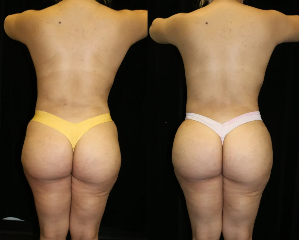 Back View Brazilian Butt Lift before and after photo by Dr. Tsai