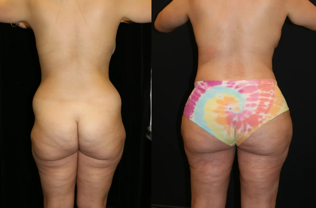 Back View Brazilian Butt Lift before and after photo by Dr. Tsai