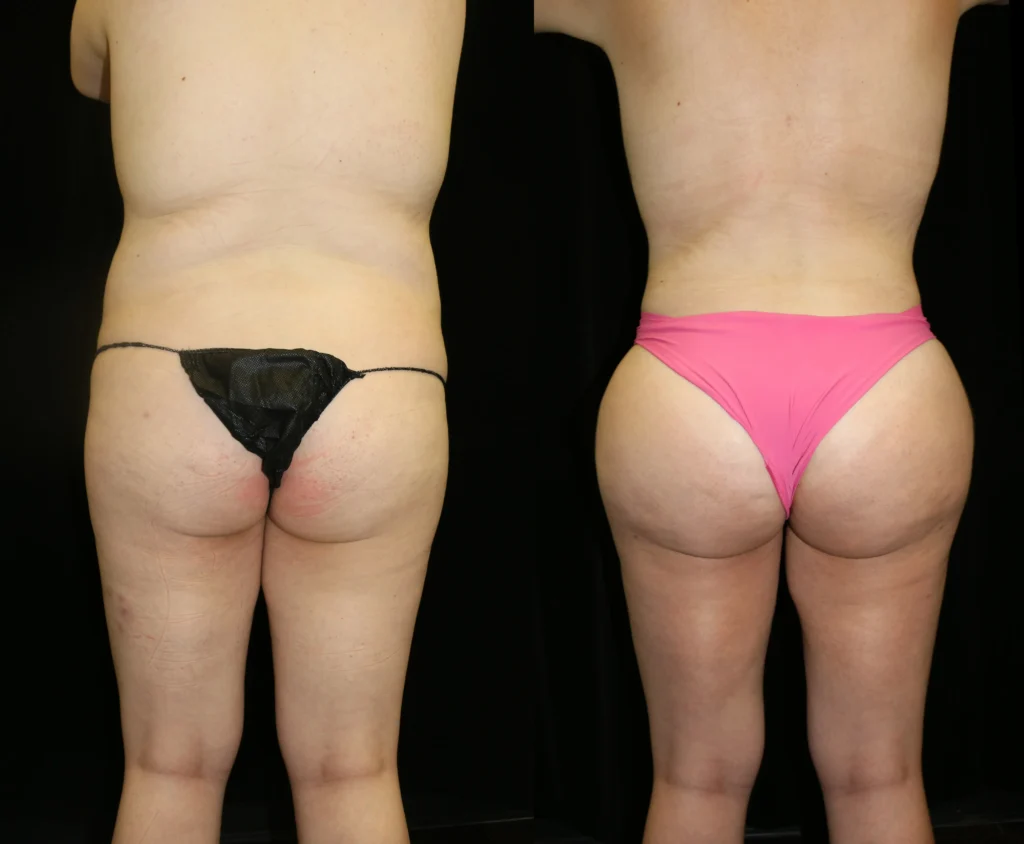 Back View Brazilian Butt Lift before and after photo by Dr. Tsai